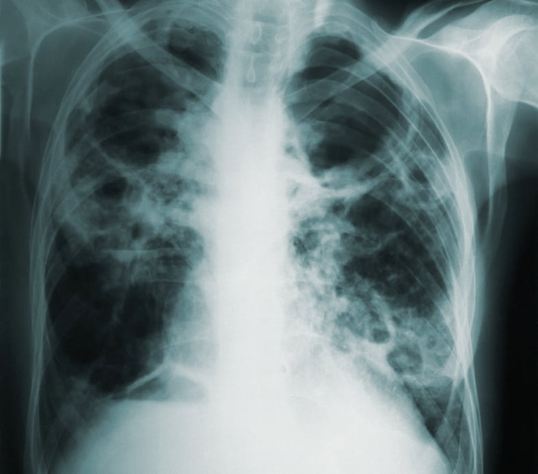 Plaque montrant les lésions pulmonaires causées par le tabagisme